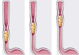 https://commons.wikimedia.org/wiki/File:Digestive_system_-_Peristalsis_2_--_Smart-Servier.png